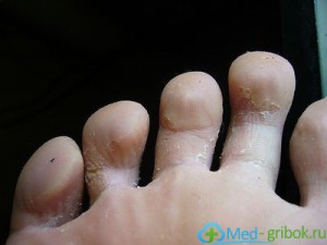 Фото грибка пальцев стопы