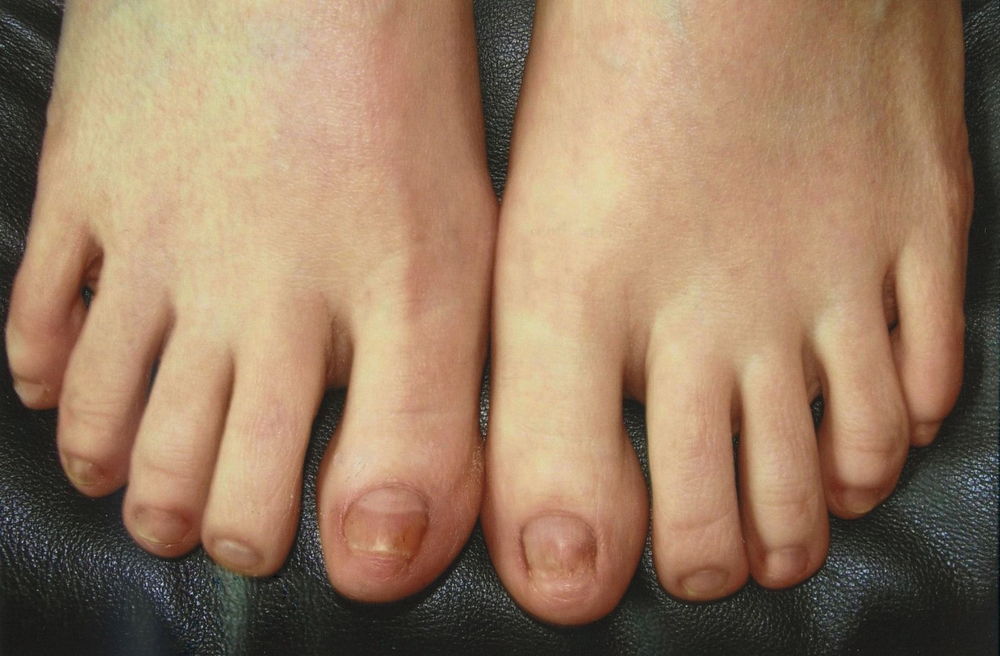 Грибок ногтей на ногах между пальцами ног фото