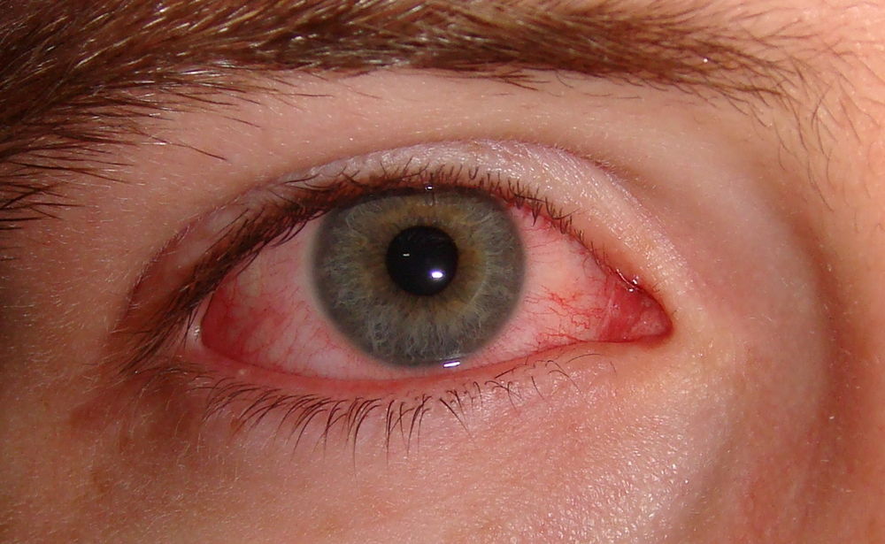 Что такое и чем опасен грибок глаз
