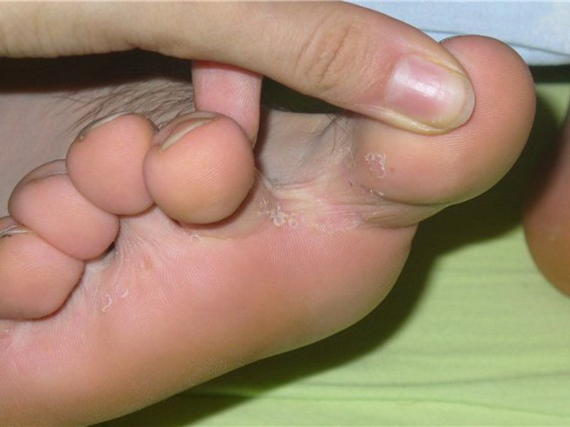 Лечение грибка между пальцами ног или рук