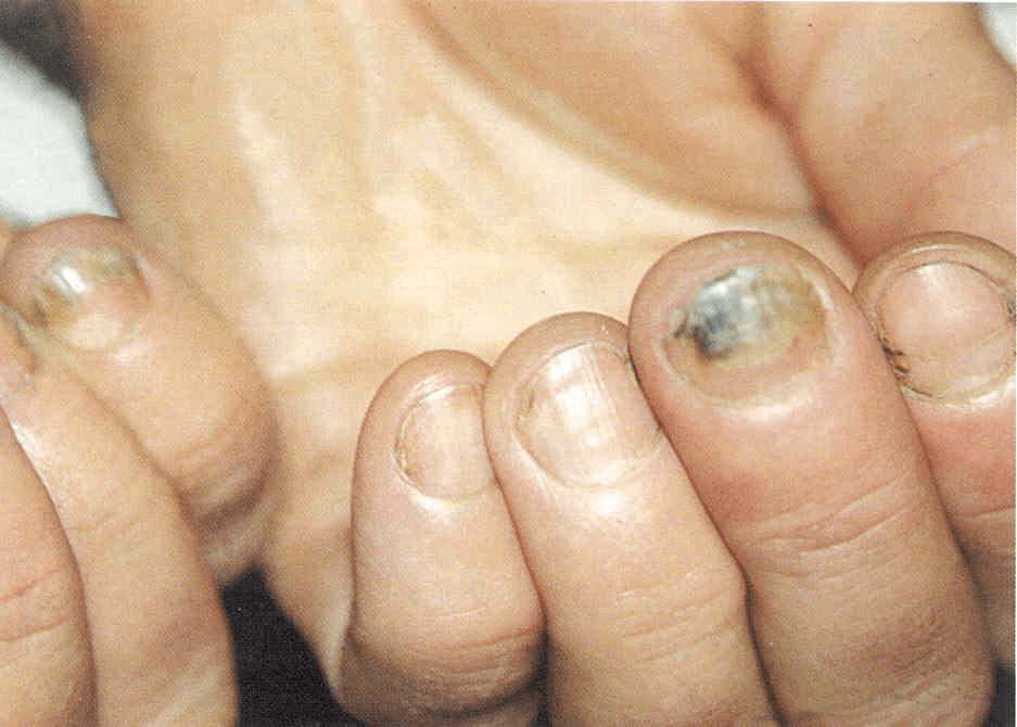 Обзор средств для удаления ногтя пораженного грибком