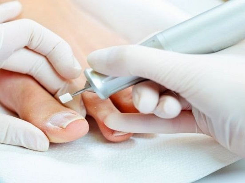Обзор средств для удаления ногтя пораженного грибком