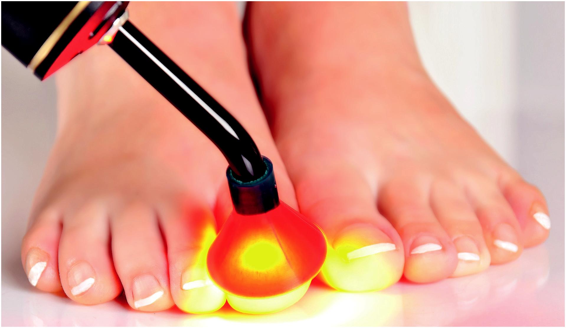 Лечение ногтевого грибка на ногах. Pact-med терапия онихомикоза фотодинамическая. Фотодинамическая терапия грибка ногтей.