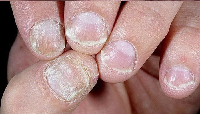 Пути заражения и способы лечения грибка ногтей на руках
