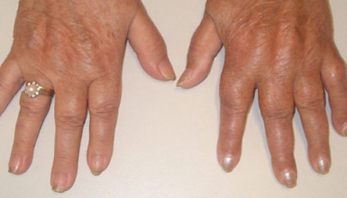 Пути заражения и способы лечения грибка ногтей на руках