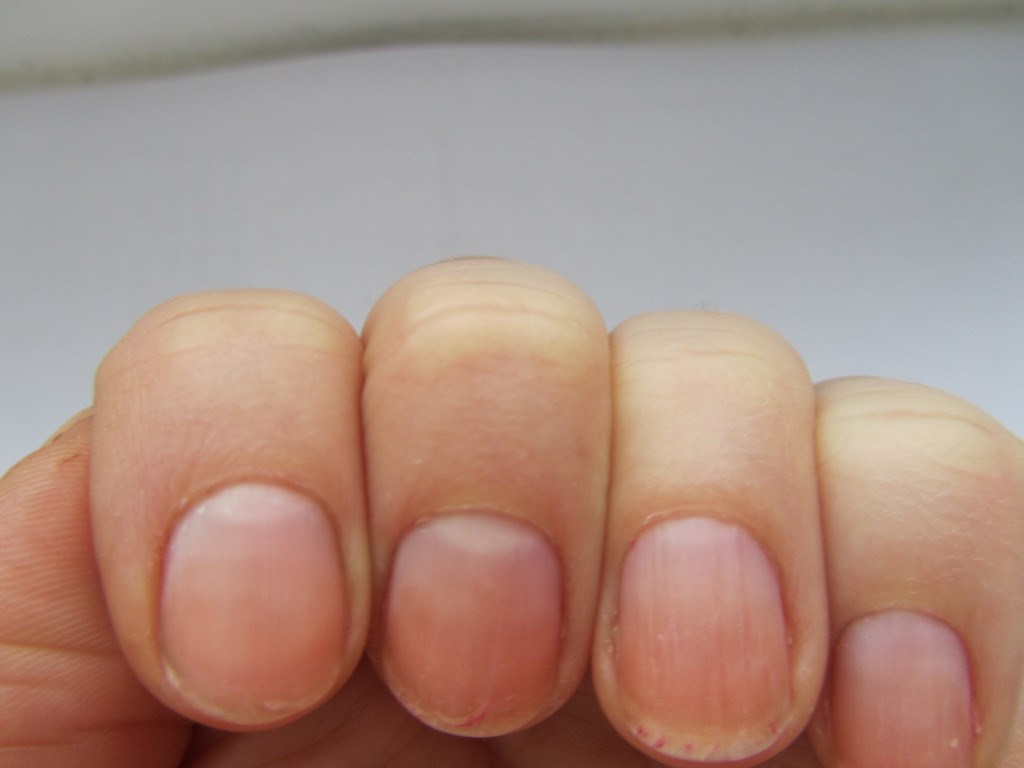 Как вылечить ребристые ногти thumbnail