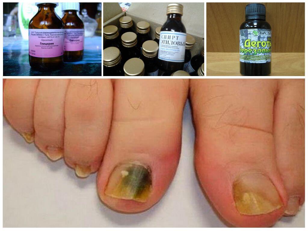 Грибок на пальцах ног лечение дегтем березовым thumbnail