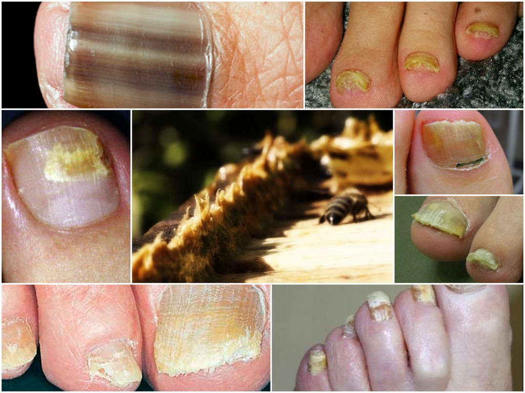 Как вылечить грибок ногтей прополисом thumbnail