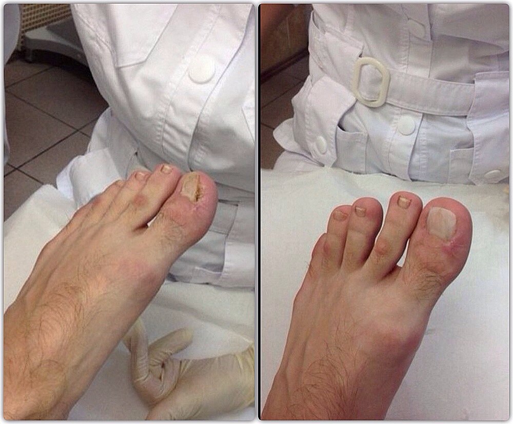 Удаление ногтя на ноге при грибке