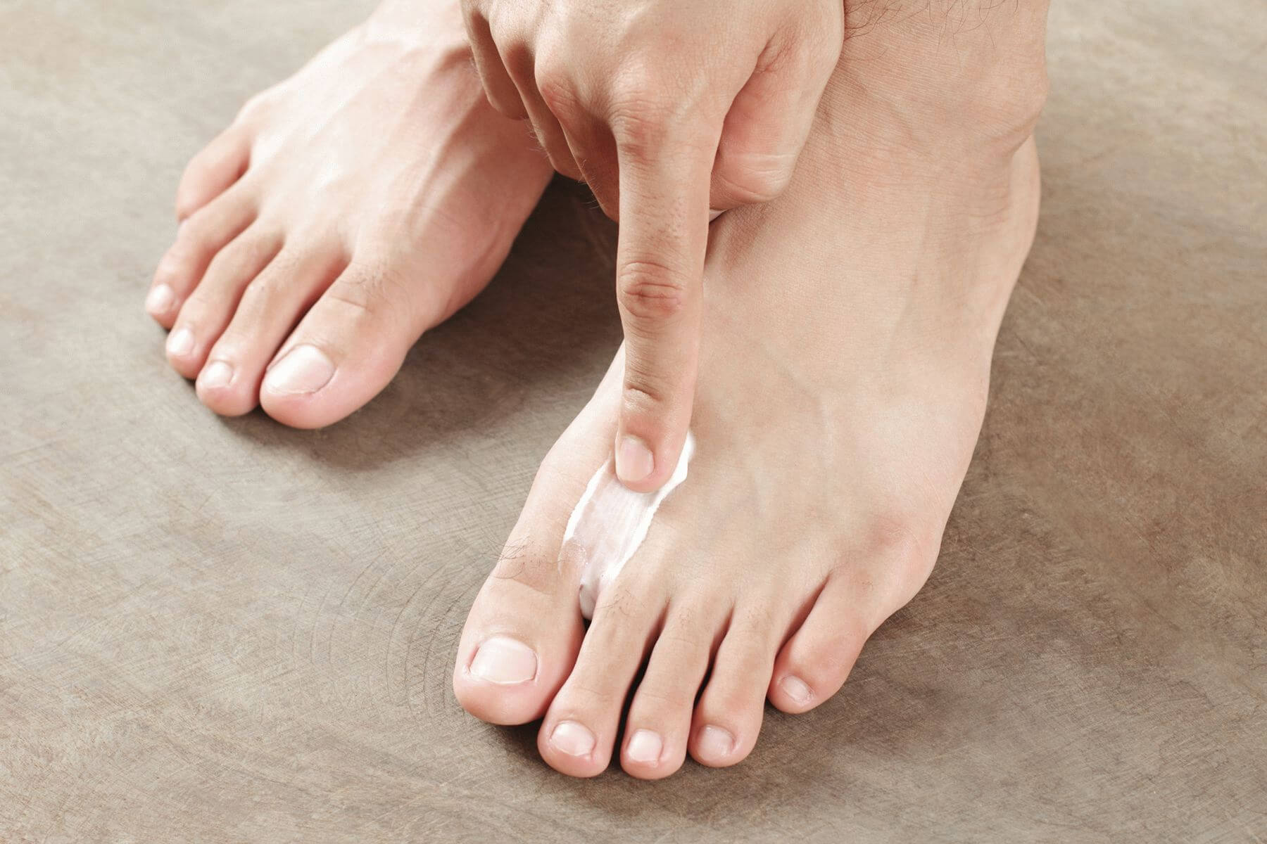 грибок на коже пальцев ног фото