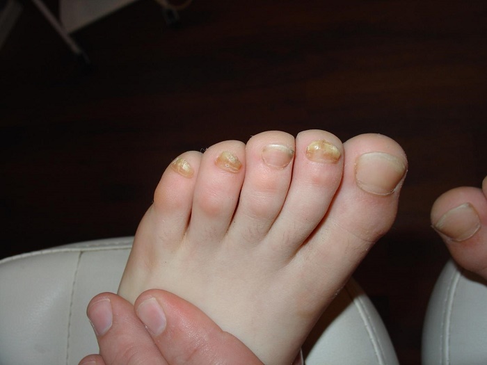 Грибок ногтей на ногах лечение препараты у детей thumbnail