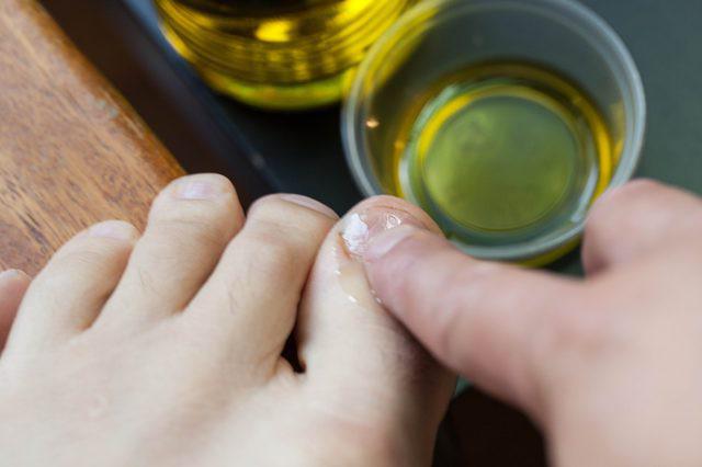 Лечение грибка ногтей народными средствами: самые эффективные способы