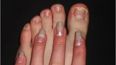 Методы лечения грибка ногтей уксусом