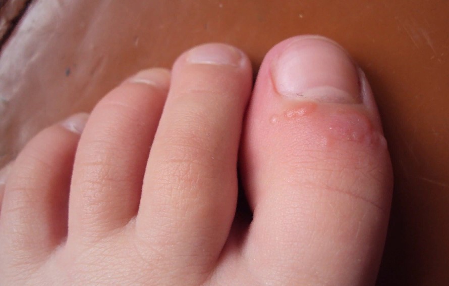 На пальцах ног появились водяные пузырьки и чешутся: что делать и как лечить