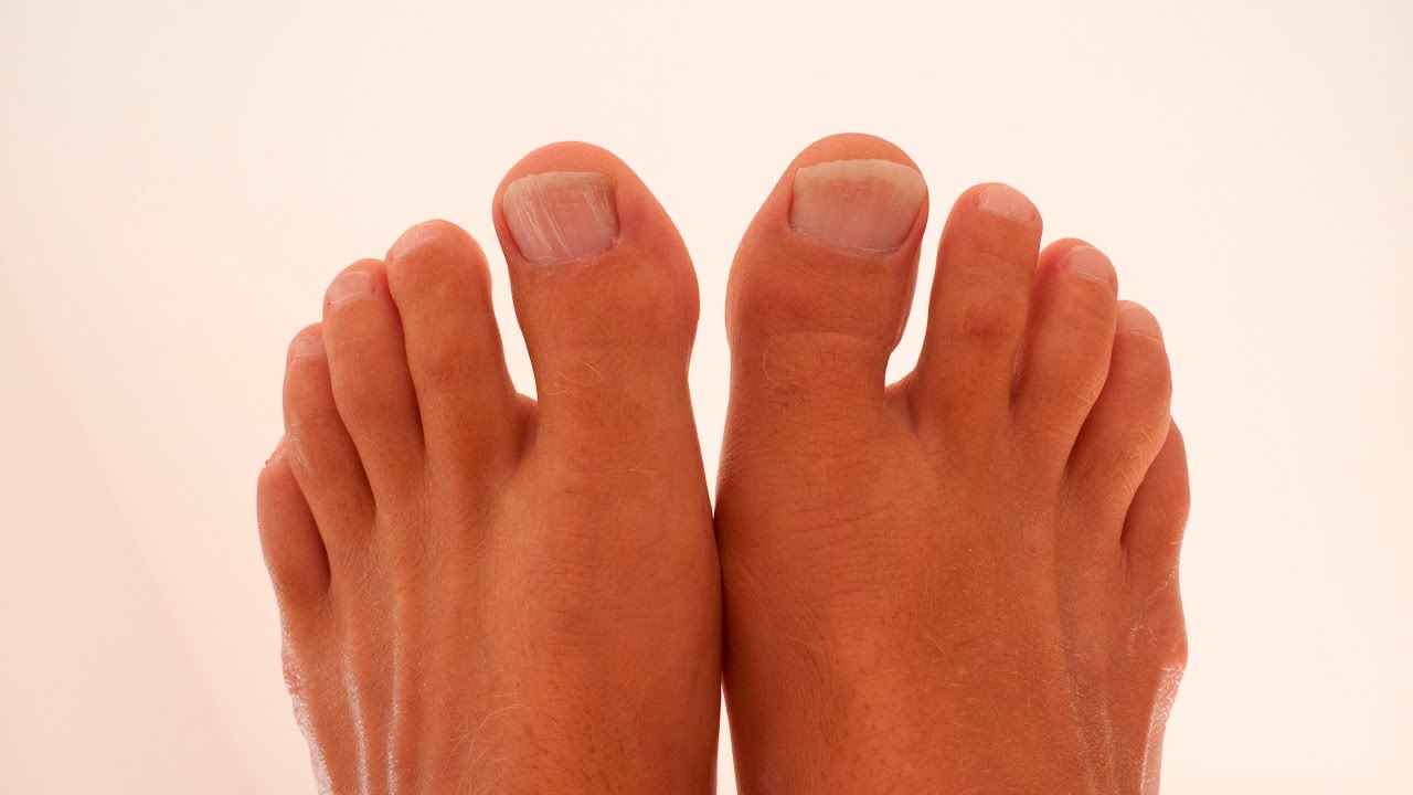 Что за болезнь пузырьки на пальцах ноги thumbnail